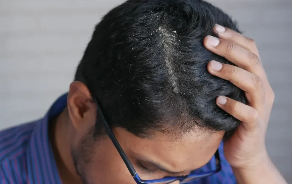 Which Styling Products Carry the Highest Dandruff Risk